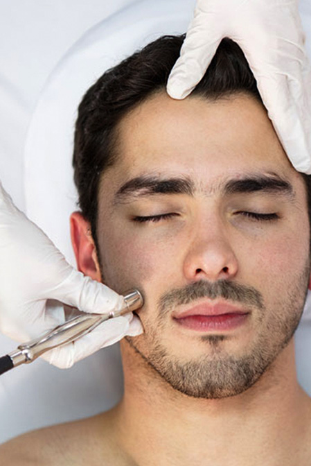Man receiving microdermabrasion on his cheek