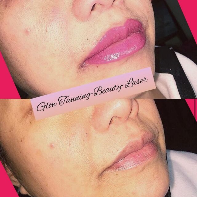 👄 Lips micropigmentation or Permanent Makeup. The colour look will be more settle and natural, after the healing time. The final result in 5-6 weeks, after which touch up will follow 👄 
.
.
.
.
.
.
👄👄👄👄👄👄👄👄👄GLOW👄👄👄👄👄👄👄👄👄👄
.
.
.
.
.
.
.
#permanentmakeup #permanentmakeuplips #pmulips #pmulips💋 #lipspigmentation #lipstattoo #tattoolips #pmulipslondon #micropigmentation #micropigmentationlips #micropigmentationlips💋