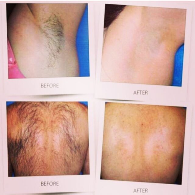 Laser Hair Removal - to get rid of all unwanted hair! Our system from Lumenis it’s a High power diode laser which is very effective giving visible results only after 1 session! It treats all skin types including skin type \/| (African) and tanned skin. Fast, efficient and currently at amazing price value. ☎️ 0208 343 0110 to book a free consultation.