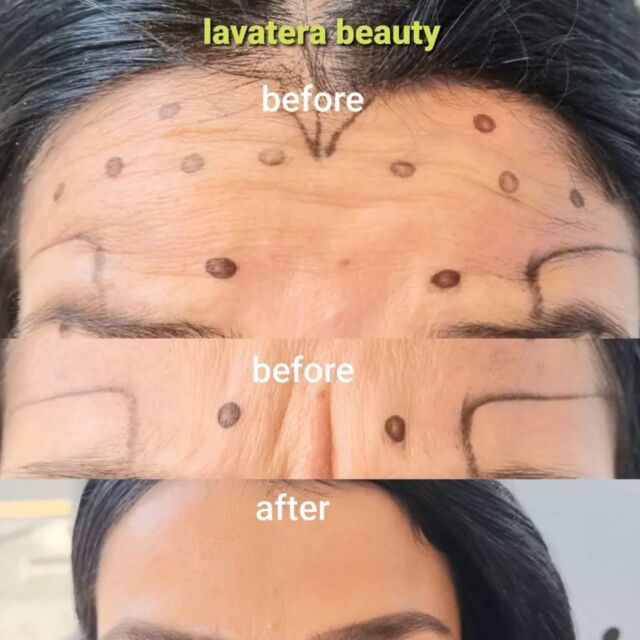 Anti wrinkle injections to get rid of unwanted deep lines , book @lavaterabeauty